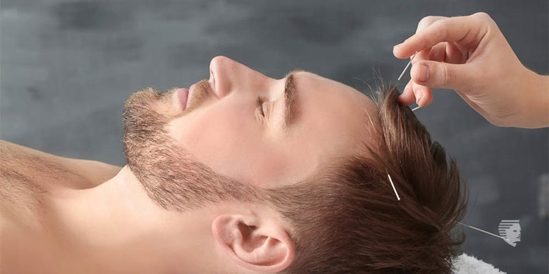 Hair Filler Acupuncture